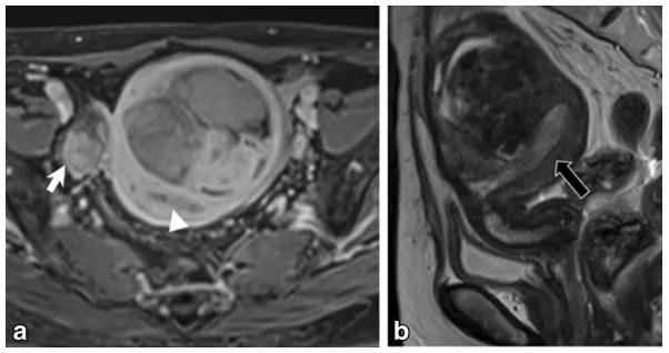 卵巢实性为主肿瘤，这13种你都想到了吗？