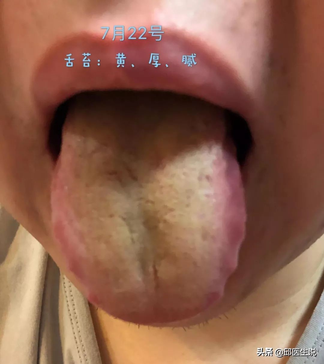 解决身体的湿气的偏方,身体湿气太重自己在家怎样除掉