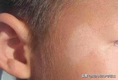 皮肤出现白斑吃什么好,皮肤发现白斑怎么办