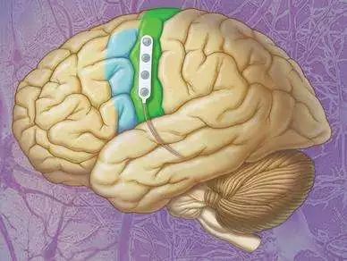 下肢截瘫康复成功案例,全国治疗截瘫最新突破