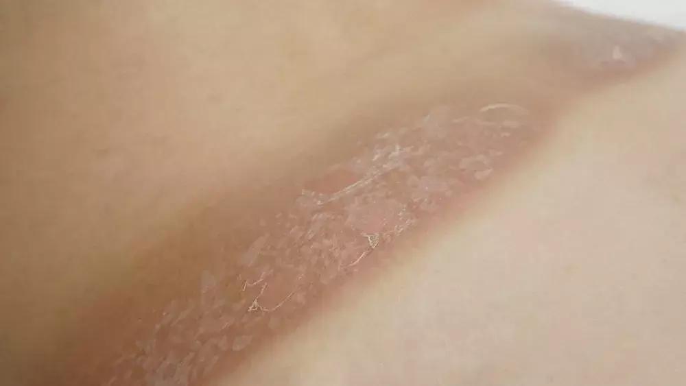 人脸晒黑怎么快速变白,手晒黑了怎样快速变白