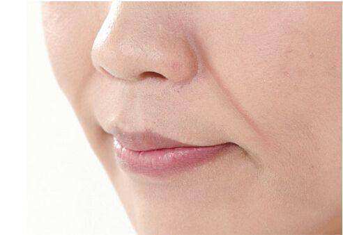 法令纹明显增深,皮肤松弛法令纹明显怎么办