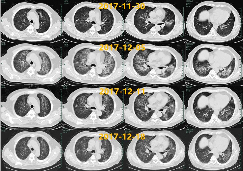 专家讲新冠二次感染的情况讲解,感染新冠专家怎么说
