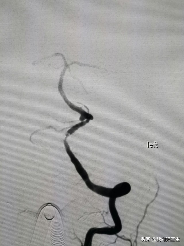 放入支架腰疼怎么办,支架后头晕怎么回事