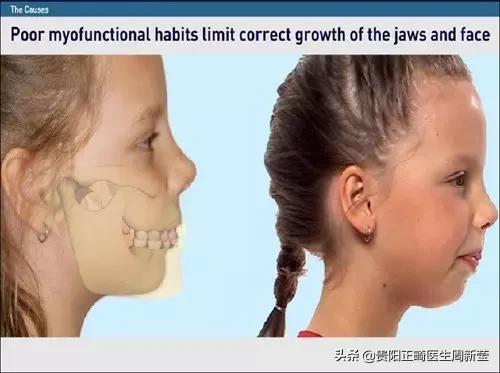 12岁前必须解决的错颌畸形,孩子十二岁牙畸形怎么办