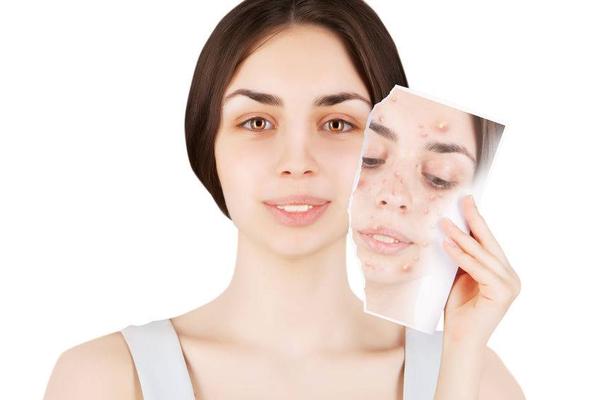 红色痘印和灰色痘印怎么祛除,脸上有痘印多运动可以淡化痘印吗