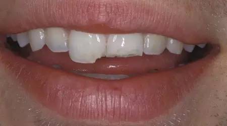 口腔溃疡是不是疱疹性口腔炎,口腔的常见20种疾病及治疗方法