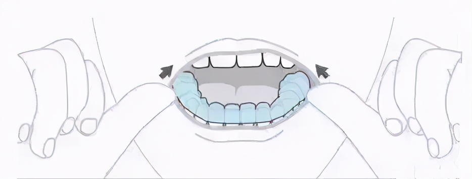 戴隐形牙套如何100分护理？