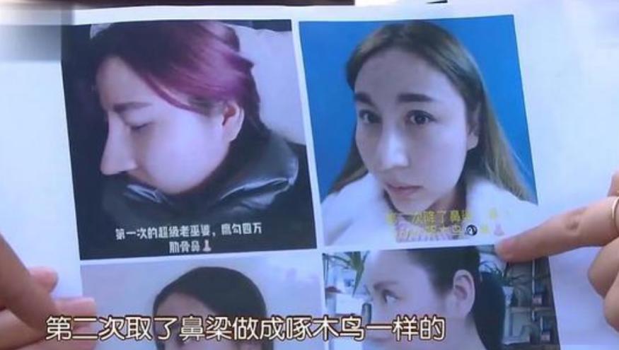 女子花6万元隆鼻被整歪,女子花4万鼻子被整歪