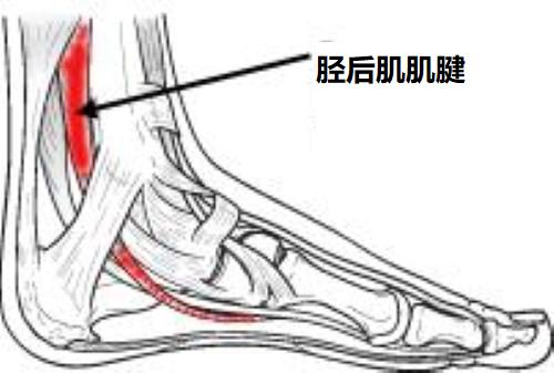 治疗扁平足,聊聊足弓塌陷