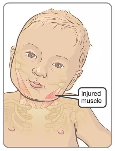 二十天的新生儿斜颈一天按摩几次,宝宝头总是往一边扭头是斜颈吗