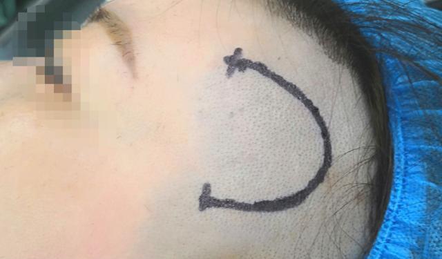 什么是偏头痛手术？患者手术的位置在什么地方？（图）一文了解