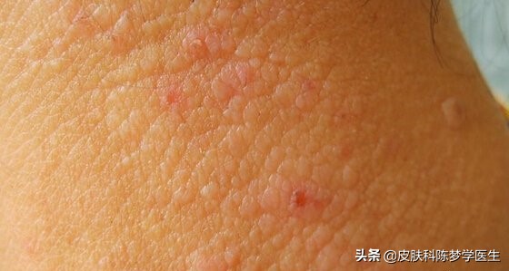 突然就得了牛皮癣,突然得了牛皮癣