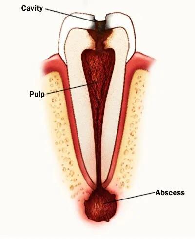 蛀牙不补能不能戴牙套,蛀牙不补认真刷牙可以防止变严重吗