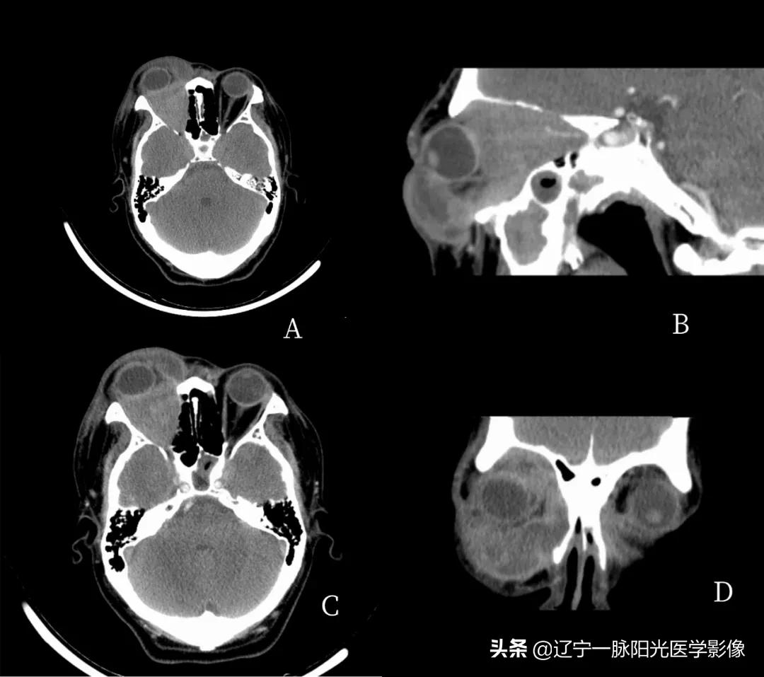 眼部肿瘤治疗有哪些,眼部肿瘤症状有哪些