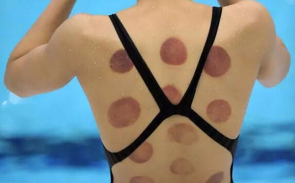 拔火罐有水泡是湿气重吗,拔火罐拔出水泡然后烂了