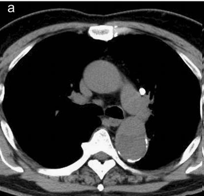 胸部Ct平扫能查出主动脉夹层吗,主动脉夹层cta影像图片解读