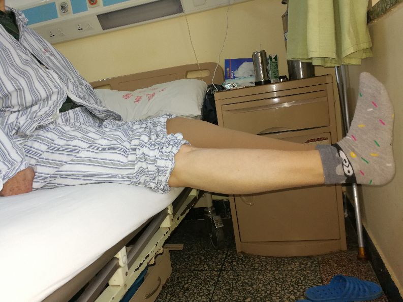 膝关节骨性关节炎诊断及治疗,膝关节骨性关节炎症状及治疗