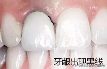烤瓷牙十几年了有必要更换吗,烤瓷牙套里的牙烂了有什么症状