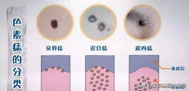 中药点斑好还是激光祛斑好,脸上有斑打激光过后吃有讲究吗