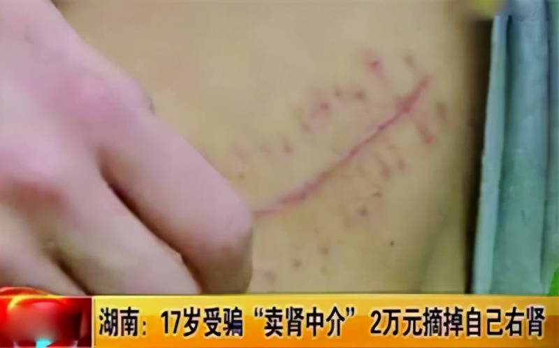 10年前，那个卖肾买手机的少年，获赔147万后过得怎样？