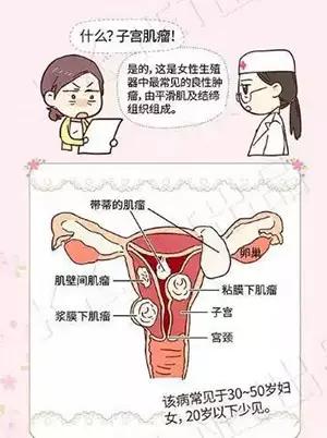 血管介入科主治,介入手术治疗妇科疾病