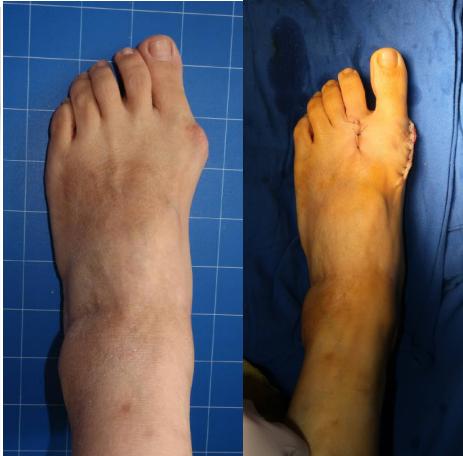 拇外翻陈医生,骨科陈医生治脚后跟疼痛