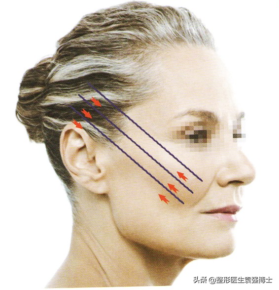 线雕“过时”了？医生说出实情