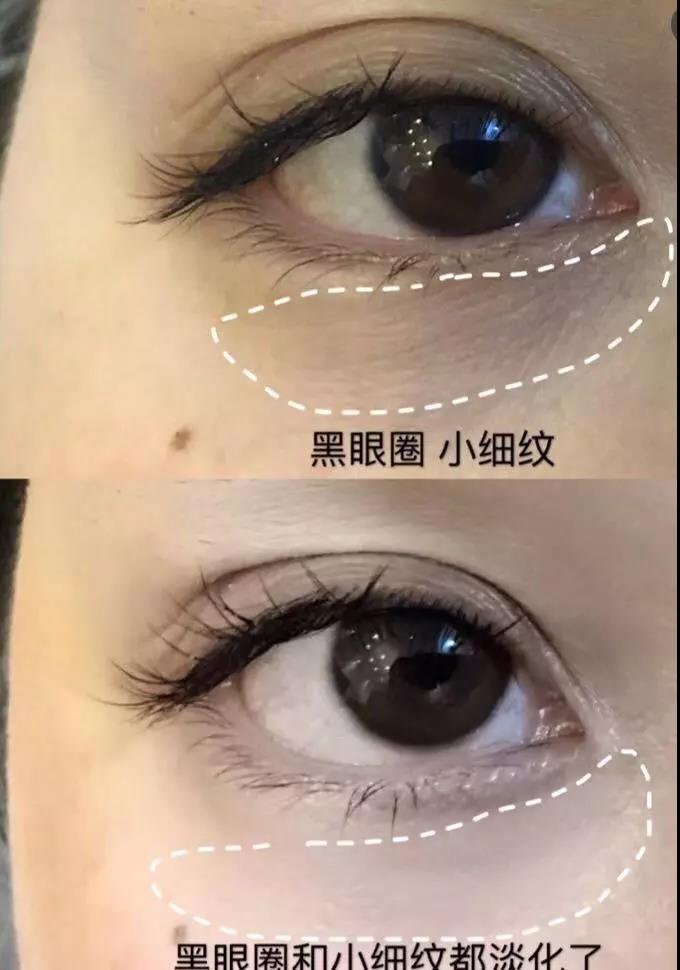 眼睛黑眼圈显老怎么办,眼睛黑眼圈大眼袋怎么消除