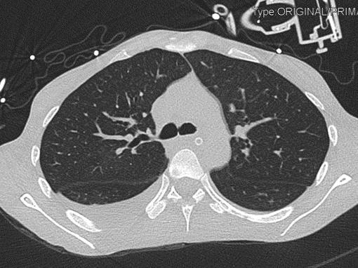 重度高碳酸血症突出表现,出现消化系统疾病的临床表现