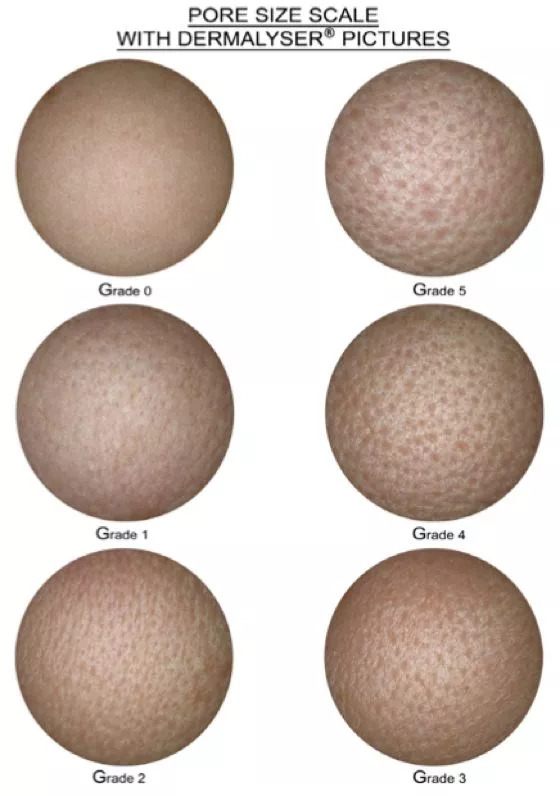 6级毛孔粗大怎么办,毛孔粗大的六个级别