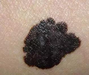 52岁脸上出现老年斑怎么办,47岁脸上有老年斑怎么治