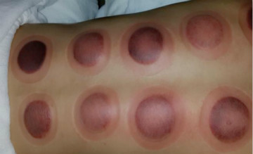 拔罐千万别瞎拔,去中医院拔火罐怎么弄