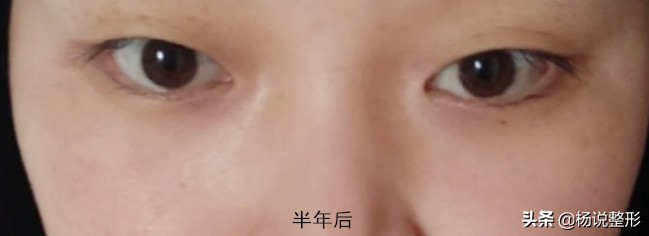 皮秒会反黑吗,皮秒反黑可以继续做皮秒吗