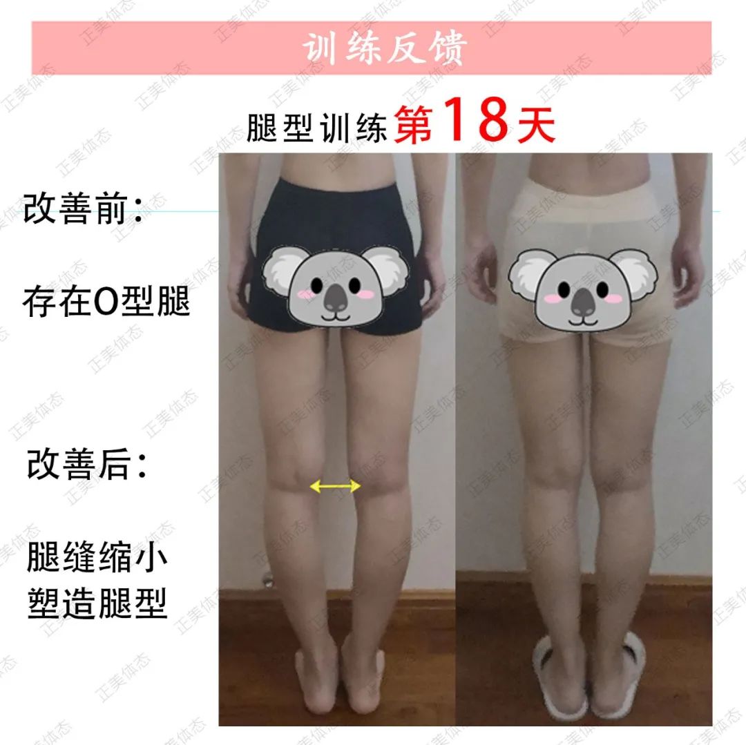 老年o型腿最快变直的方法,o型腿适合穿什么类型鞋