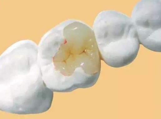 补牙学问,补牙真的是小洞不补大洞吃苦吗