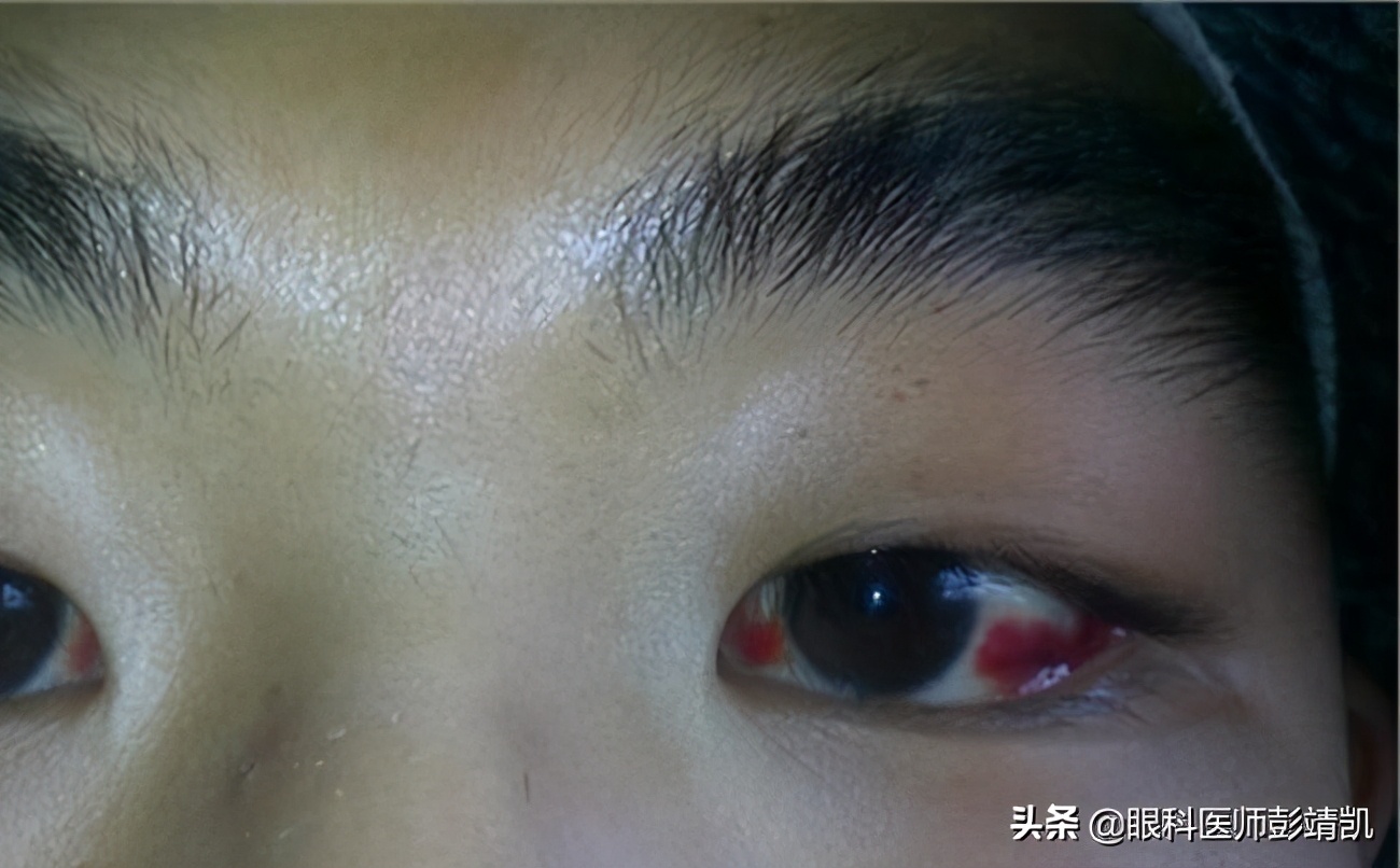 眼睛红了去医院治疗,眼睛红了一片怎么办