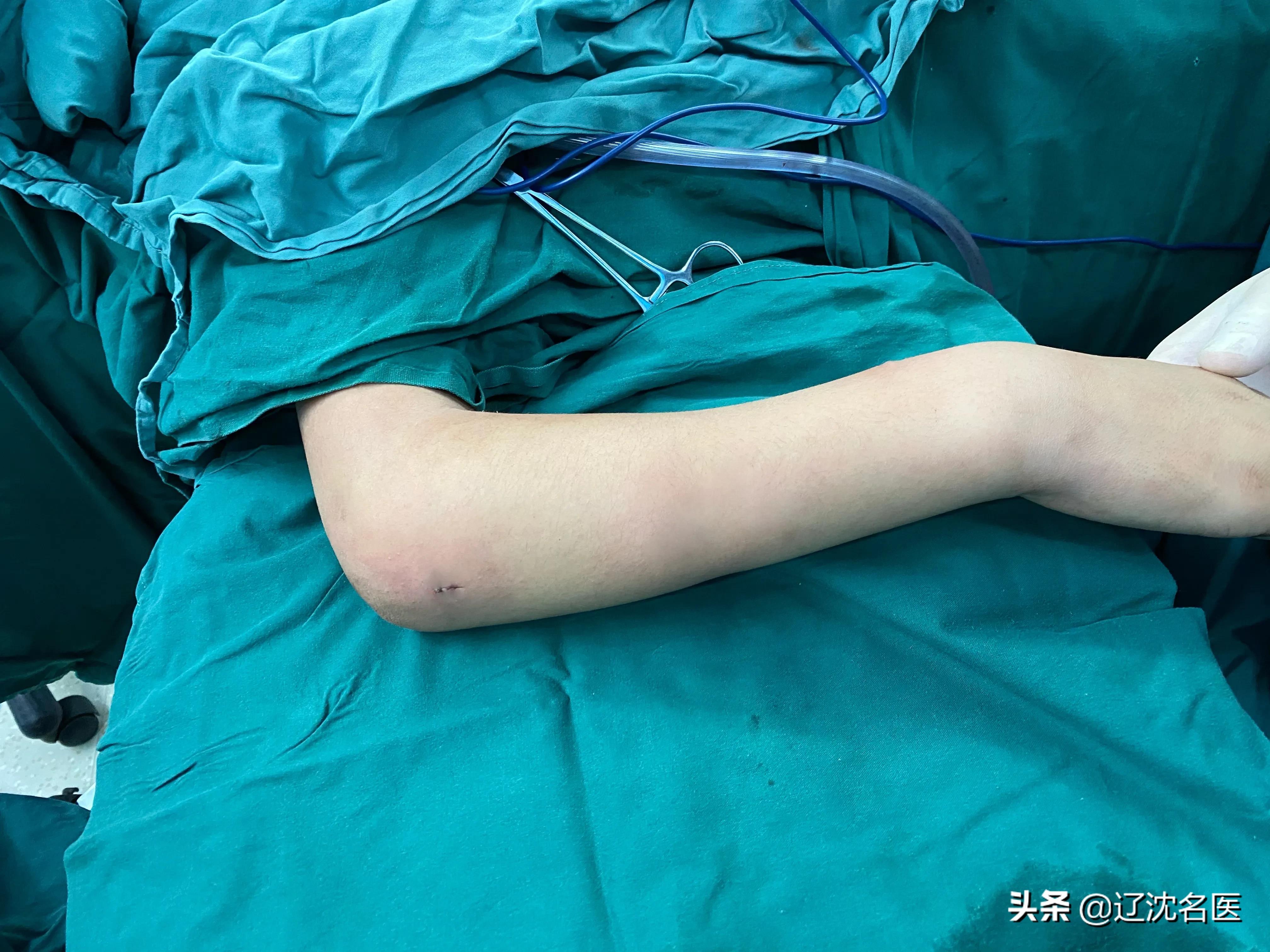 儿童尺桡骨双骨折保守治疗后错位,六岁儿童桡骨颈骨骨折多久恢复