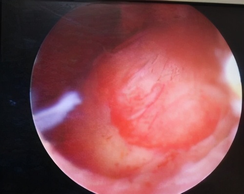 乐山市中医医院妇科大力开展冷刀宫腔镜手术治疗