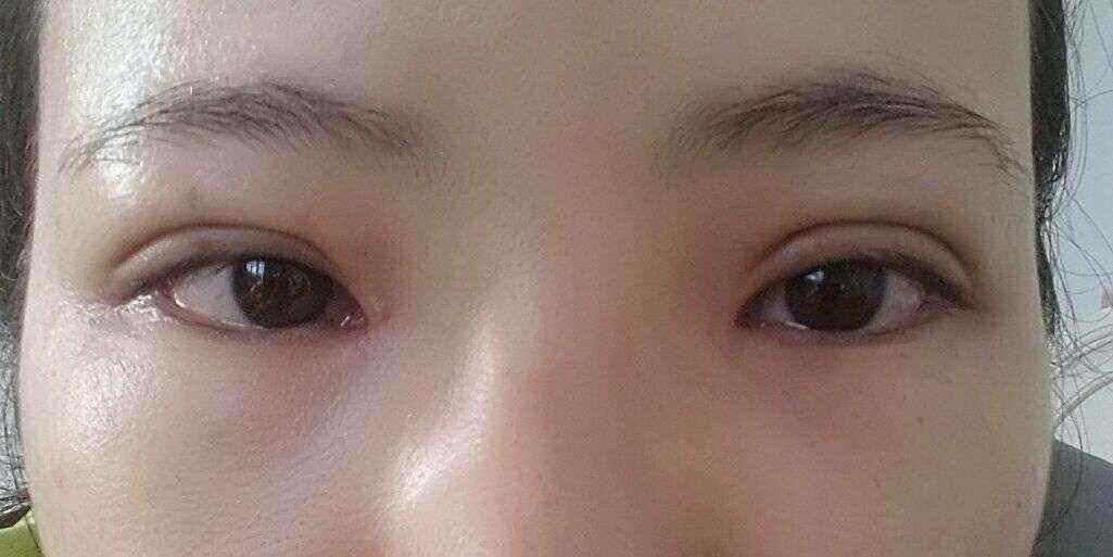 割双眼皮的危害和后遗症,割双眼皮失败还能补救吗