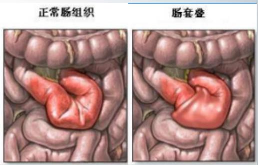 雨女无瓜的佛系带娃：孩子频繁呕吐要警惕！出现这一情况或要手术