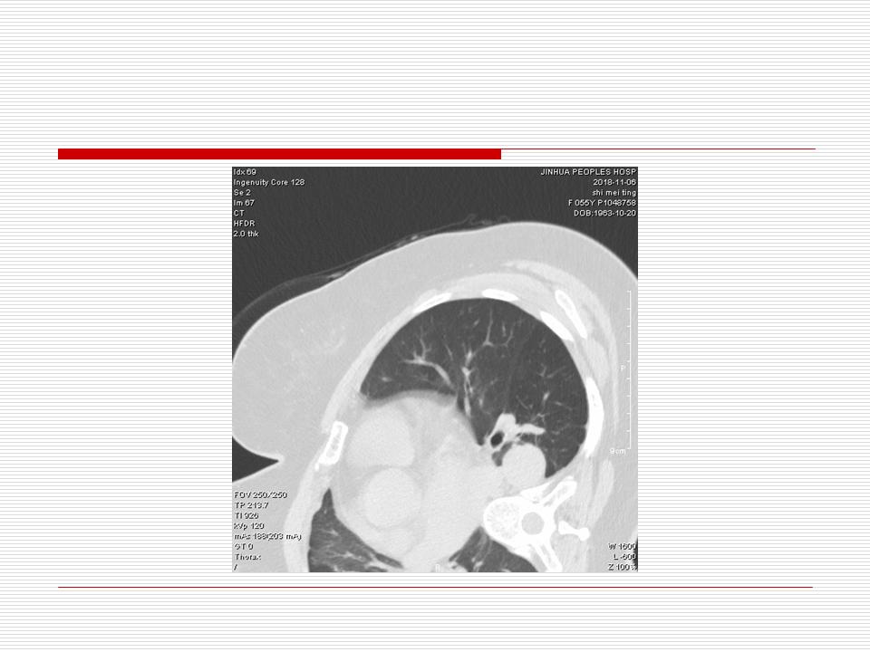 像炎症的肺癌能治好吗,医生说可能是肺癌也可能是炎症
