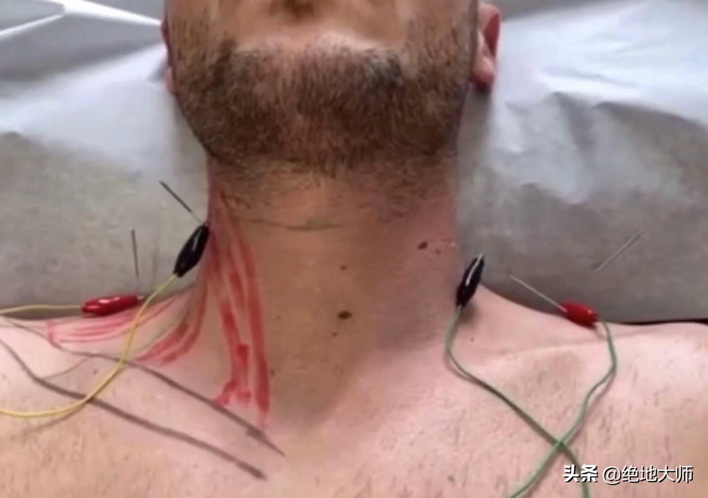 急性颈痛的神经调控康复治疗