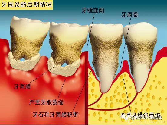 告诉你个秘密，“无齿”的原因是……
