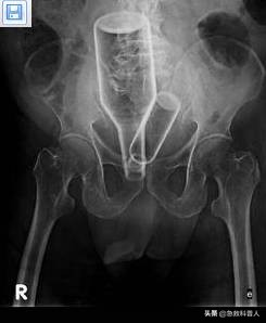 卡住食道怎么办,一个人被卡住食道怎么办