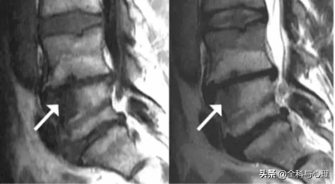 腰痛要警惕四种原因肾不好,盘点腰痛常见病因及防治训练