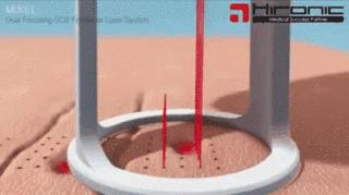 如何处理痘痘留下来的黑印,痘痘留下的痘痕怎么快速消除