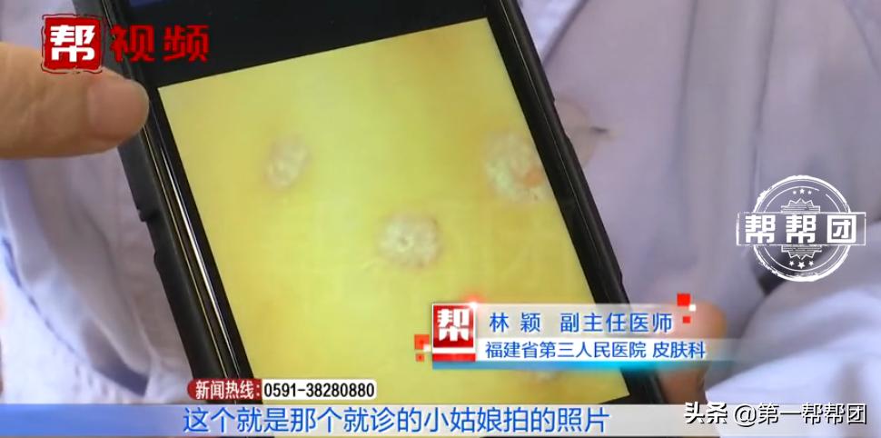 人传染上猫癣身上痒,七岁女孩染上猫癣