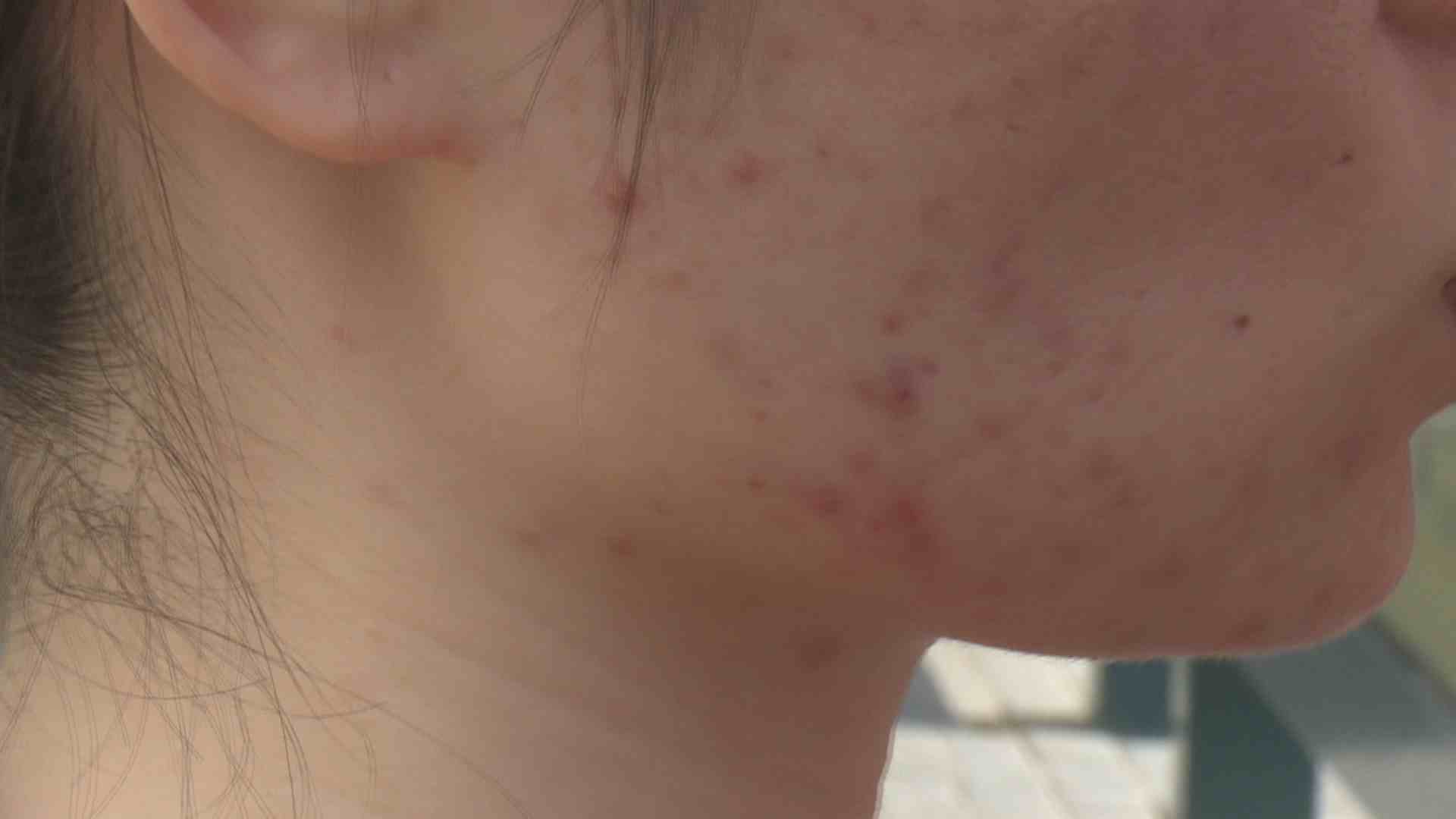 深圳一女子美容2年花108万,深圳一女子花5万元祛痘