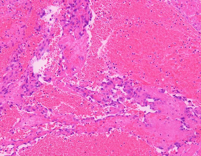 弥漫性肺泡出血能治好吗,弥漫性肺泡出血能活多久